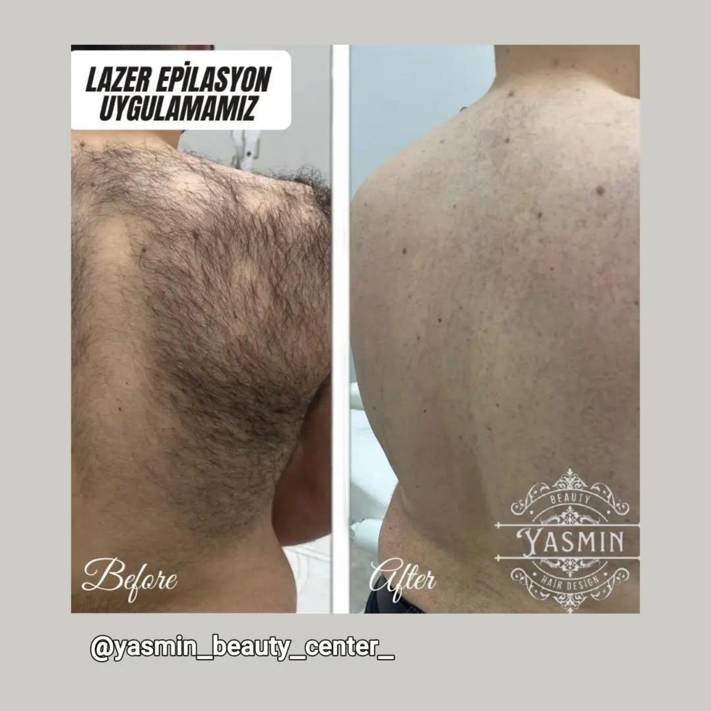 bay lazer epilasyon