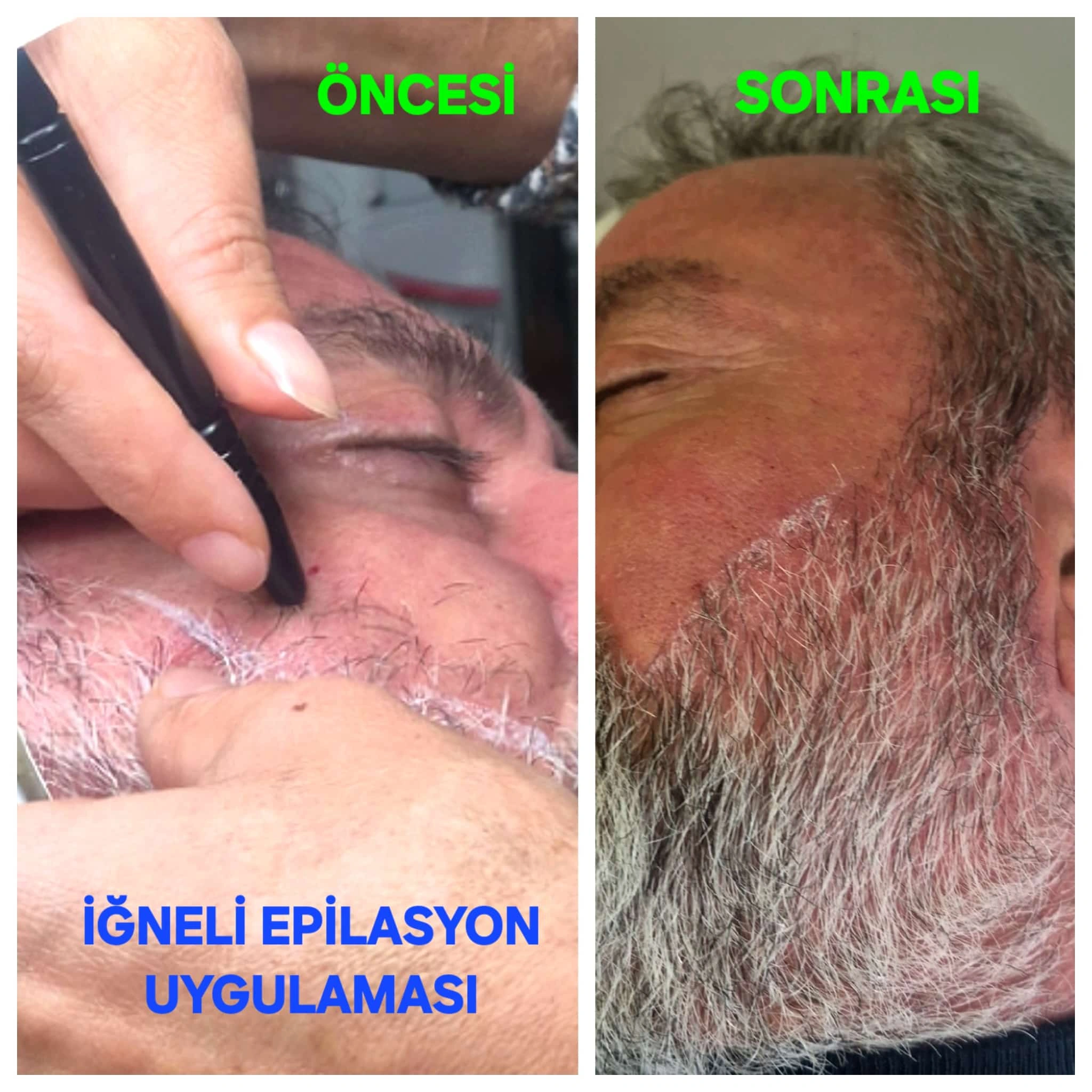 bay iğneli epilasyon